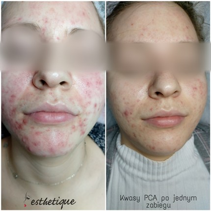 pca skin kwasy efekty kosmetyczka Jarocin